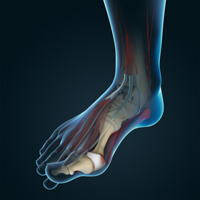 Bunion Educational Picture