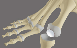 Cartiva Joint Replacement