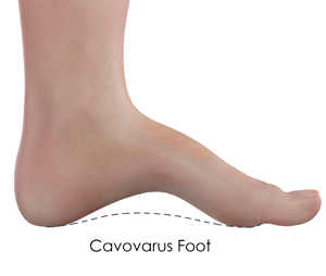Cavovarus Foot Correction Educational Picture