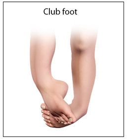 Clubfoot Educational Picture