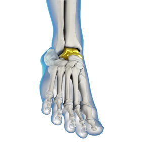 Custom 3D Printed Ankle Replacement Educational Picture