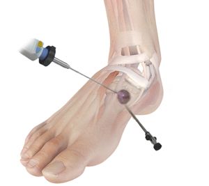 Cyst Removal Educational Picture