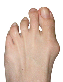 Dance Injuries of the Foot &  Ankle