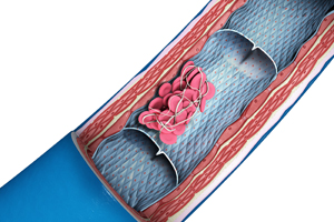 Deep Vein Thrombosis (DVT)