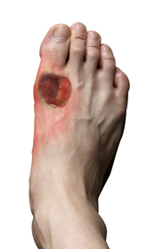 Diabetic Foot Care Educational Picture