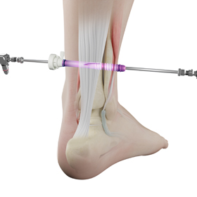 Endoscopic Achilles Lengthening