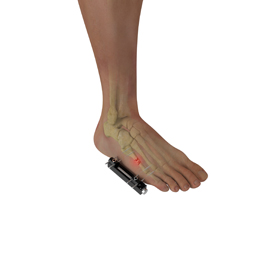 External Fixation for Foot &  Ankle Trauma Educational Picture