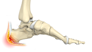 Fat Pad Cushion Restoration Educational Picture