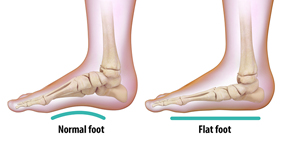 Flatfoot Reconstruction Educational Picture