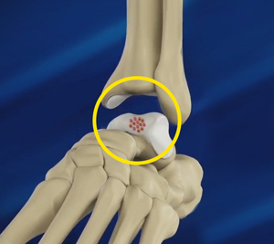 Foot and Ankle Cartilage Repair Educational Picture
