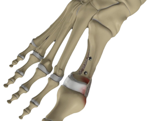 Foot &  Ankle Osteotomy