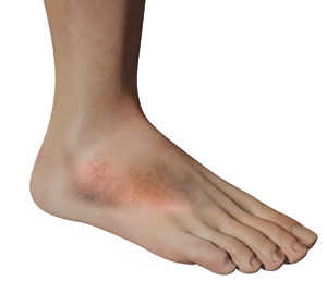 Foot Inflammation Educational Picture