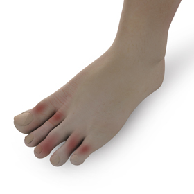 Foot Lesions Educational Picture