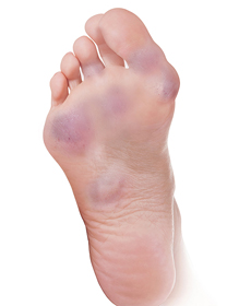 Foot Rheumatoid Arthritis Educational Picture