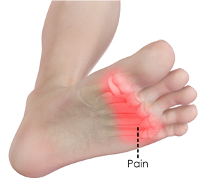 Forefoot Pain Educational Picture