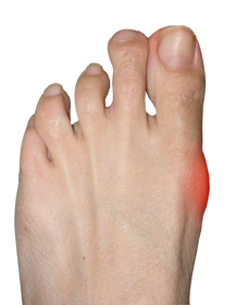 Hallux Limitus Educational Picture