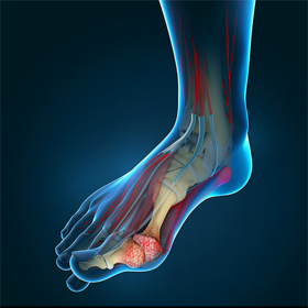 Hallux Rigidus Educational Picture