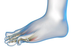 Hammertoe Educational Picture