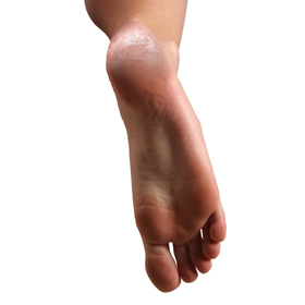 Heel Fissures Educational Picture