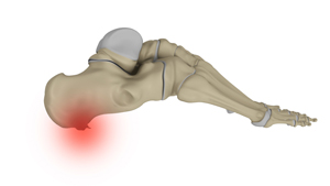 Heel Spurs Educational Picture