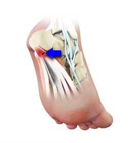 Heel Surgery Educational Picture