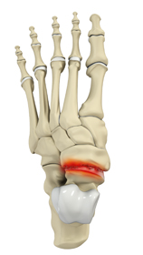 Hindfoot Arthritis Educational Picture