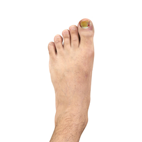 Ingrown Toenail Wedge Resection Educational Picture