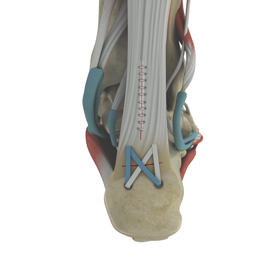 Insertional Achilles Debridement (spur removal) and Repair