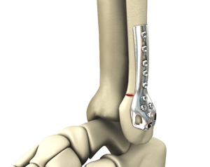 Internal and External Fixation of Foot &  Ankle Fractures Educational Picture