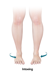 Intoeing Educational Picture