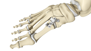 Lapidus Bunionectomy