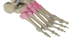 Lisfranc (Midfoot) Fracture Educational Picture