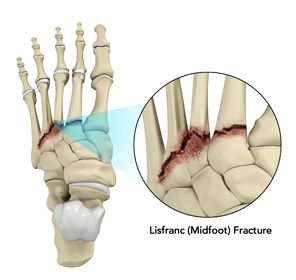 Lisfranc (Midfoot) Injury Educational Picture
