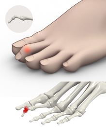 Mallet Toe Educational Picture