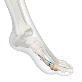 Metatarsal Osteotomy
