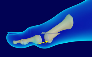 Metatarsal Surgery Educational Picture