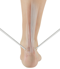 Minimally Invasive Achilles Repair Educational Picture