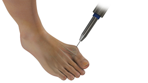Minimally Invasive Bunion Surgery Educational Picture