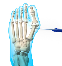 Minimally Invasive Foot &  Ankle Reconstruction