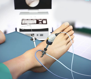 Minimally Invasive Foot Surgery Educational Picture