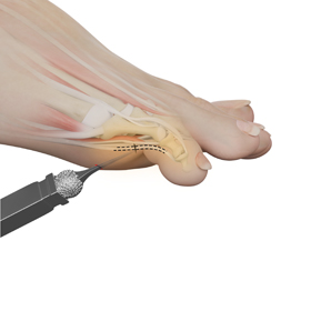 MIS Hammertoe Surgery