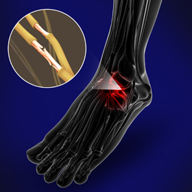 Nerve Conditions of the Foot Educational Picture