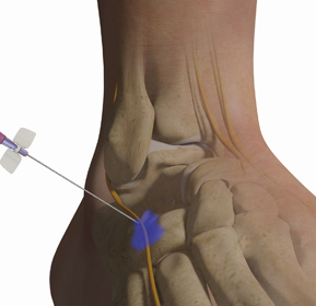 Neurolysis for Neuroma Educational Picture