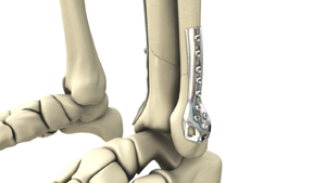 Open Reduction and Internal Fixation of the Foot Educational Picture