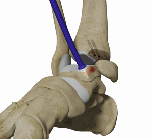 Osteochondral Allograft Transplantation System (OATS) of the Ankle Educational Picture