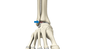 Osteochondral Injuries of the Ankle Educational Picture