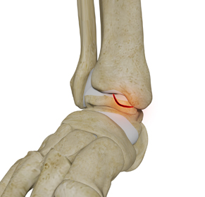 Osteochondral Lesions of the Ankle Educational Picture