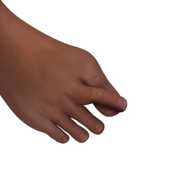 Overlapping or Underlapping Toe Educational Picture