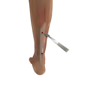 Percutaneous Achilles Tenotomy