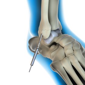 Percutaneous Reduction Internal Fixation (PRIF) of the Foot